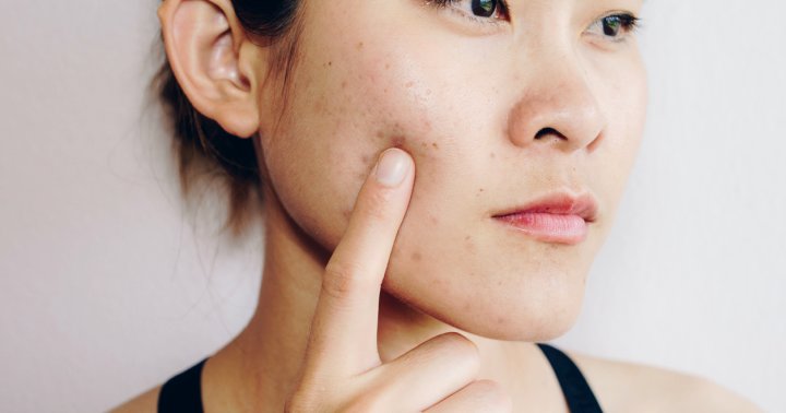How To Conceal Indented Acne Scars, From A Makeup Artist