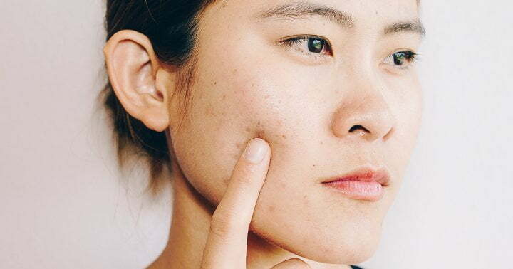 4 Dermatologist-Approved Tips For Dealing With Dry & Acne-Prone Skin