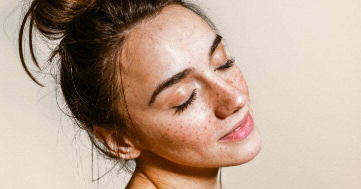 Do You Have Freckles, Melasma Or Dark Spots? Tips For Identifying Each