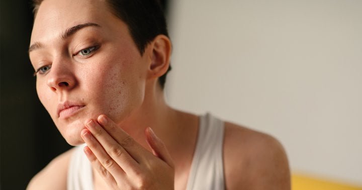 Is Your Breakout Actually Just Your Skin "Purging?" How To Tell